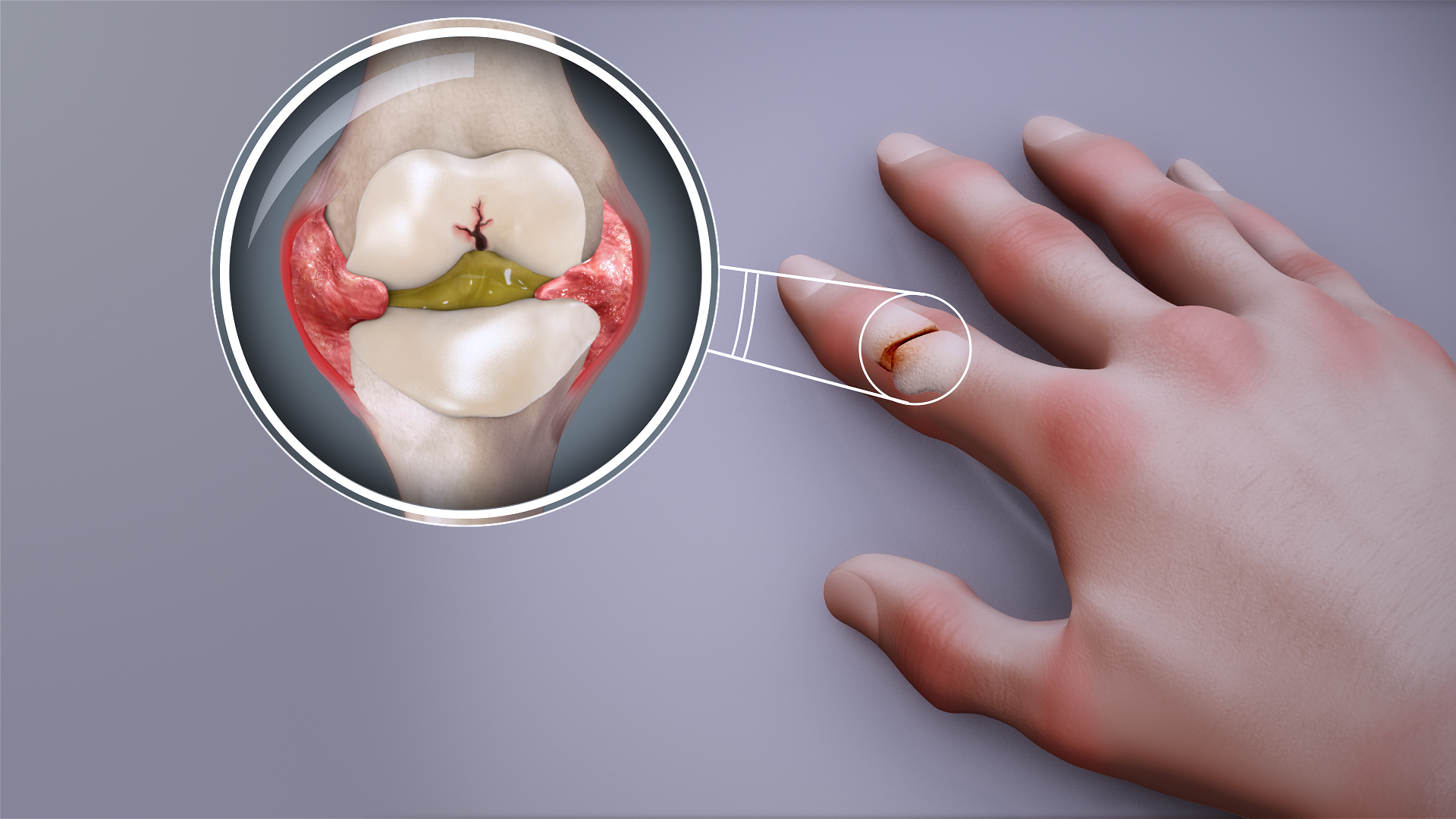 Anti Rheumatic