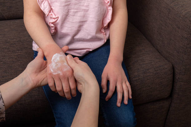 Steroid  Topical